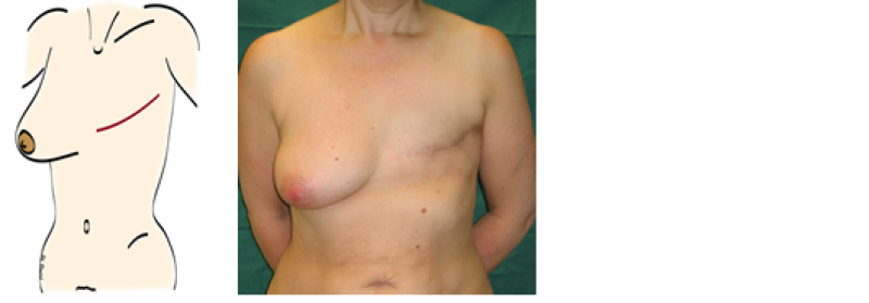 mastectomy1