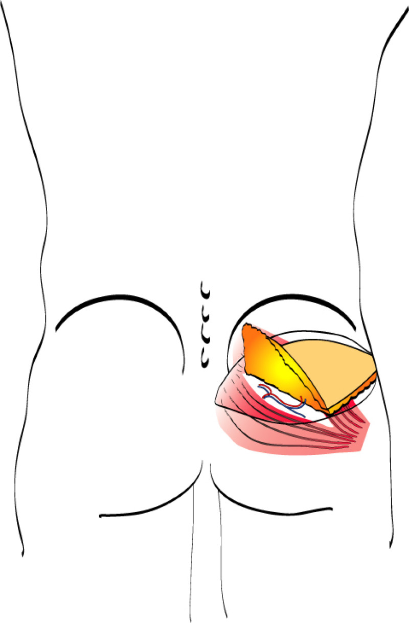 Glutealfig4b