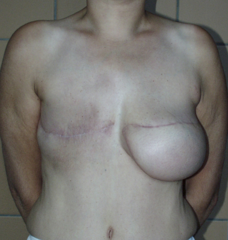 Alternative flaps fig1a