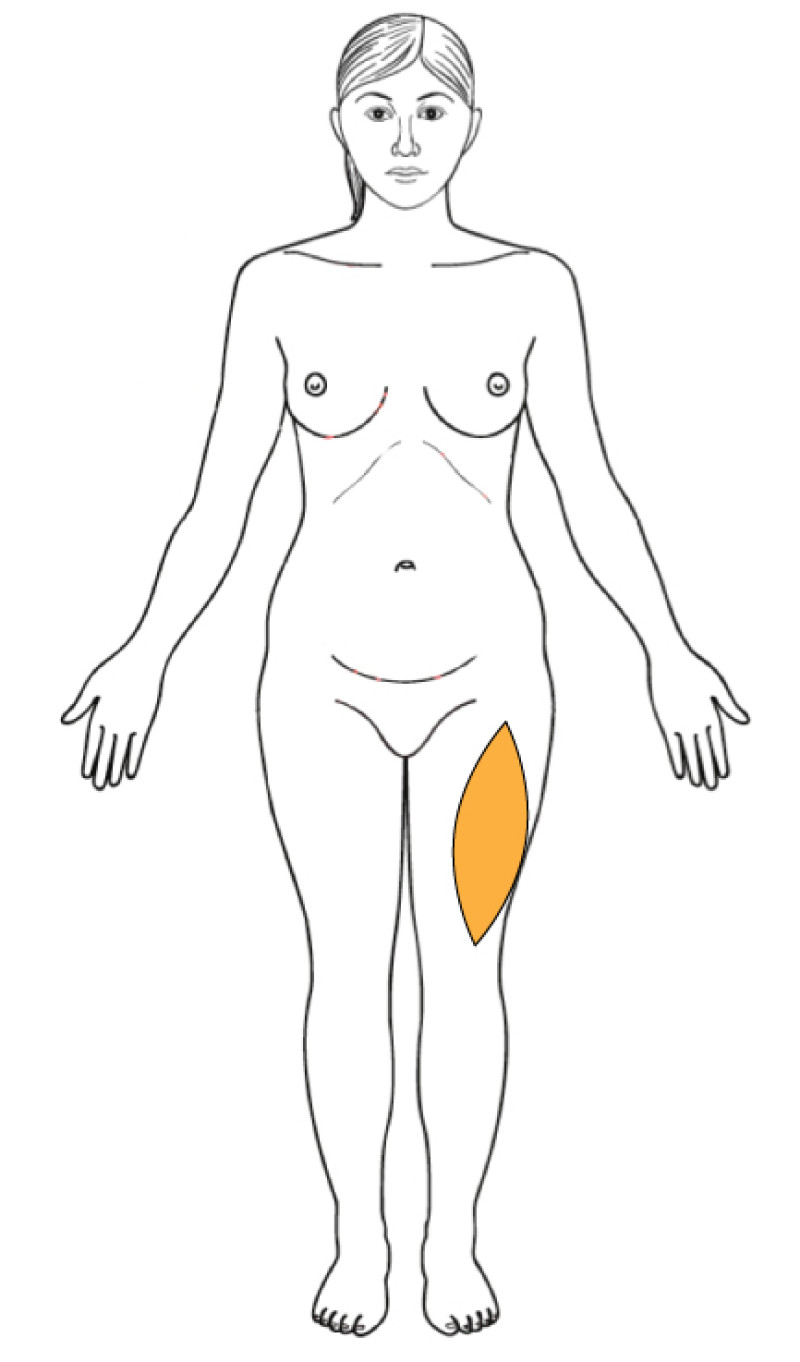 Alternative Flaps fig4