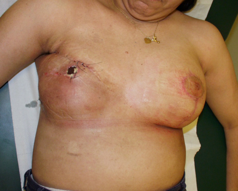 complications implants fig8