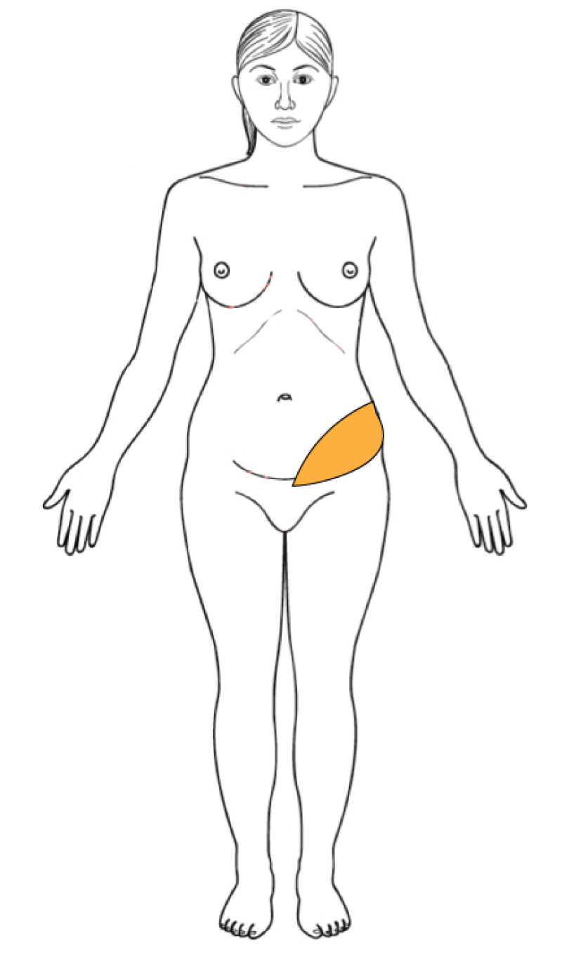 Alternative Flaps fig3