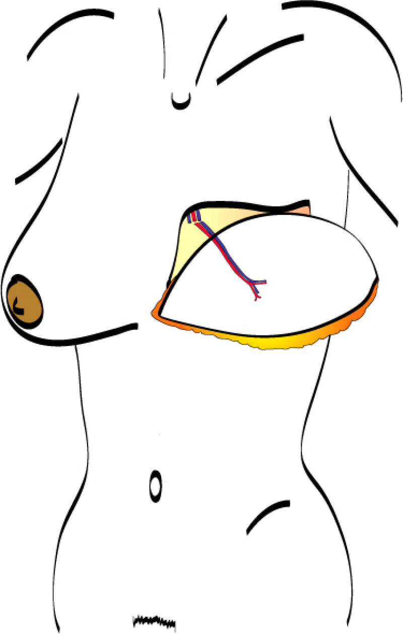 Glutealfig4d