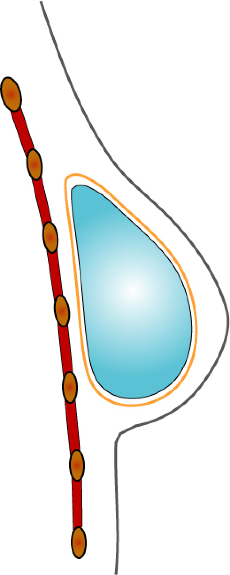 complications implants fig1