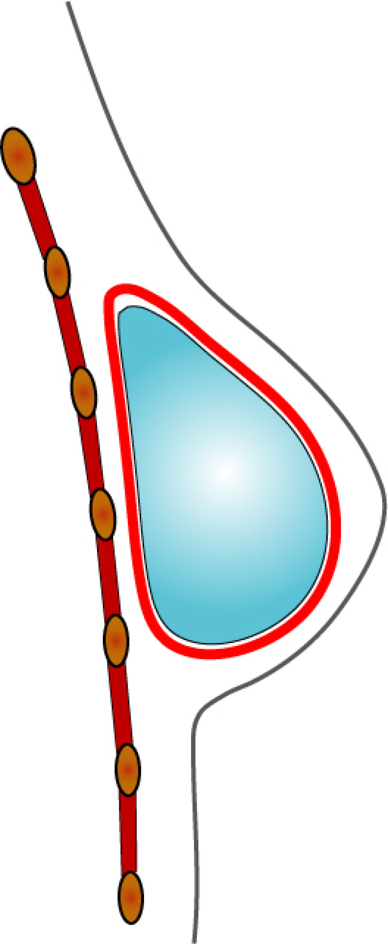 complications implants fig4
