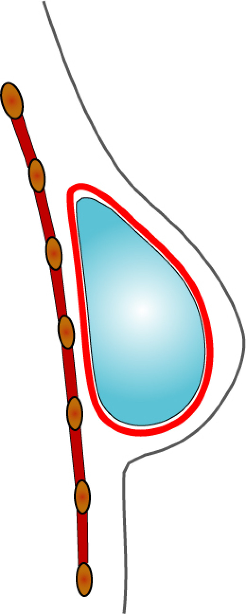 complications implants fig2