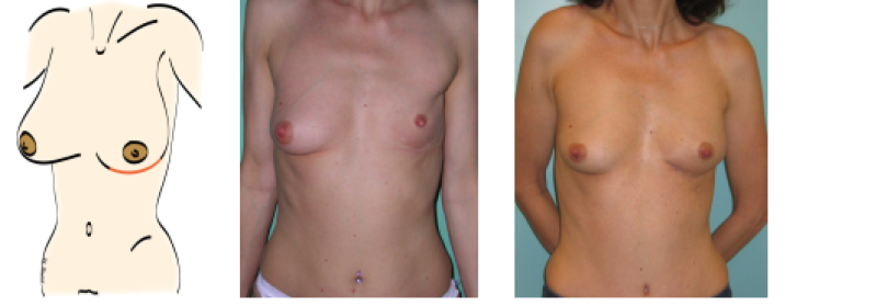 mastectomy5