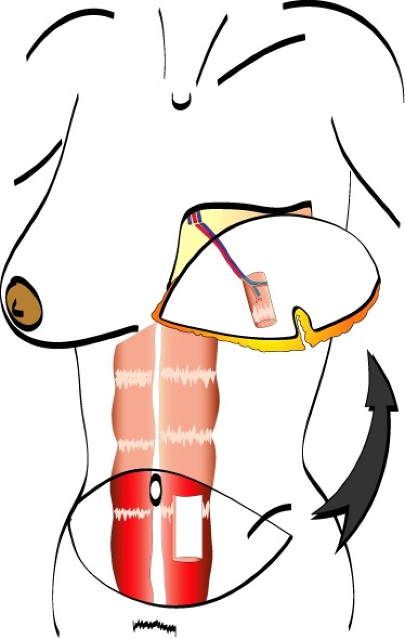 muscle sparing TRAM transfer copy 2