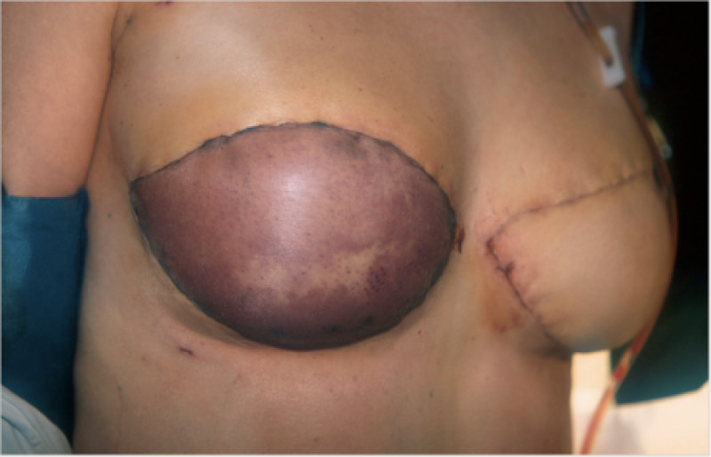 Alternative Flaps fig1b