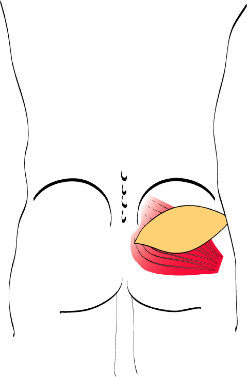 Glutealfig4a