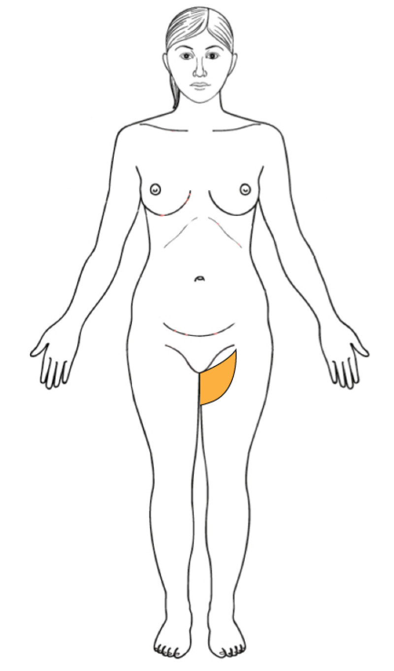 Alternative flaps fig2