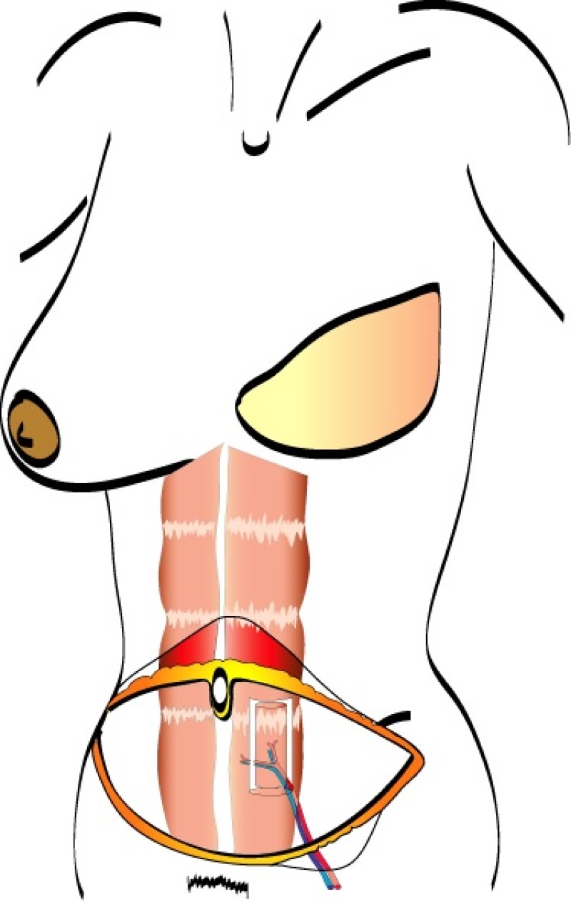 muscle sparing TRAM techniek copy 2