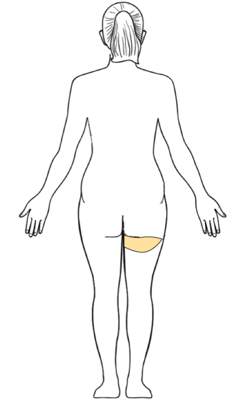 Alternative Flaps fig5